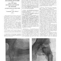1077 - Page 1051 - Travaux originaux. Des raideurs articulaires après les butées ostéoplastiques de hanche (arthropathies post-opératoires). Par MM. Tavernier et Albert Trillat...