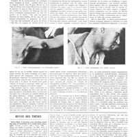 1113 - Page 1087 - Travaux originaux. La tularémie en Tchécoslovaquie. Par Jaroslav Drrohlav... / Revue des thèses. Pierre Reyt. L'apicolyse avec plombage paraffiné dans le traitement de la tuberculose pulmonaire (Amédée Legrand, édit), Paris, 1936 [G. Poix]