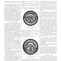 1199 - Page 1173 - Notes de médecine pratique, oto-rhino-laryngologie, publiées par les soins de M. Aubry. Le diagnostic du cancer du larynx