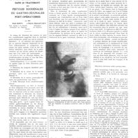 1261 - Page 1235 - Travaux originaux. Le tube d'Einhorn a demeure dans le traitement des fistules duodénales ou gastro-jéjunales post-opératoires. Par MM. Paul Santy... et Pierre Mallet-Guy...