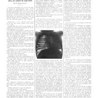1295 - Page 1269 - Petites cliniques de «la presse médicale». N° 420. Atélectasie aiguë transitoire du poumon gauche chez un enfant de sept mois. Par M. Robert Azoulay