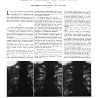 1413 - Page 1387 - Travaux originaux. Cancer et tuberculose pulmonaires associés. Par MM. Émile Sergent, Maurice Racine et Max Fourstier