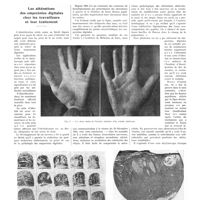 1561 - Page 1535 - Chroniques, variétés et informations. Les altérations des empreintes digitales chez les travailleurs et leur traitement