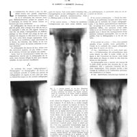 1585 - Page 1559 - Travaux originaux. La méthode des coupes radiographiques. Tomographie ou planigraphie appliquée au cancer du larynx. Par MM. G. Canuyt et Gunsett...