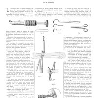 1592 - Page 1566 - Travaux originaux. Une technique d'ostéosynthèse métallique applicable aux fractures de jambe et des os longs. Par P. Alglave