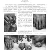 1595 - Page 1569 - Travaux originaux. Pachyonychie congénitale avec kératodermie et kératoses disséminées de la peu et des muqueuses (Syndrome de Jadassohn et Lewandowski). Par A. Touraine...