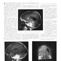 1602 - Page 1576 - Travaux originaux. Étude des modifications pneumographiques des tumeurs des ventricules latéraux. Par Harden Askenasy