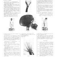 1677 - Page 1651 - Travaux originaux. Les affections endocriniennes du squelette. Par G. Coryn / Bibliographie