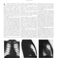 1771 - Page 1745 - Travaux originaux. Le pneumomédiastin artificiel au point de vue diagnostic et thérapeutique. Par Luigi Capani