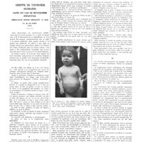 1797 - Page 1771 - Travaux originaux. Greffe de thyroïde humaine dans un cas de myxoedème infantile. Résultats suivis pendant 12 ans. Par R. Le Fort...