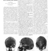 1811 - Page 1785 - Petites cliniques de «la presse médicale». N° 430. Paralysie unilatérale des six derniers nerfs crâniens. Méningiome de la fosse cérébelleuse. Par André-Thomas