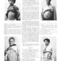 1856 - Page 1830 - Travaux originaux. Aspects théoriques et pratiques du traitement humoral de l'infection paludéenne. Par le Prof. Maurizio Ascoli... / Bibliographie