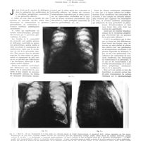 1857 - Page 1831 - Travaux originaux. Accrétion sans concrétion (Contribution à l'étude de la pathogénie des péricardites adhésives et de l'hypertension veineuse active). Par le Prof. Luigi Condorelli...