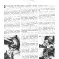 1864 - Page 1838 - Travaux originaux. Remarques sur la technique de la résection gastro-duodénale. Par le Prof. Mario Donat...