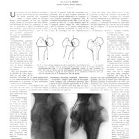 1867 - Page 1841 - Travaux originaux. L'ostéotomie intertrochantérienne dans le traitement des pseudarthroses du col du fémur. Par le Prof. V. Putti...