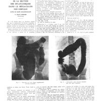1877 - Page 1851 - Travaux originaux. De la section des splanchniques dans le mégacolon non compliqué avec ou sans dolicholon. Par René Leriche...