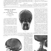 1917 - Page 1891 - Travaux originaux. Le rôle cancérigène du soleil dans les néoplasies de la peau. Par P. Gasquet... / Bibliographie / Blessure du cerveau par balle avec migration extraordinaire du projectile. Par Sigismond Landau...