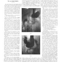 1919 - Page 1893 - Notes de médecine pratique publiées par les soins de A. Ravina. Sur une épingle déglutie