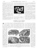 Fig. 2. Microphotographie du plus grand des concréments calcaires éliminés par l'enfant / Fig. 1. Co [...]