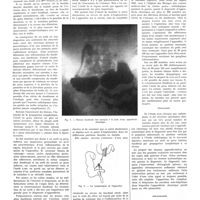 0624 - Page 620 - Travaux originaux. L'appendicite chronique. Son diagnostic par la palpation abdominale en position verticale et son retentissement duodénal avec arrêt au «genu inferius» mis en évidence par l'étude radiologique de la traversée digestive. Par M. Brodin... / Bibliographie