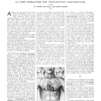 1337 - Page 1333 - Travaux originaux. La cure opératoire des péricardites constrictives. Par MM. M. Loeper, Jean Patel et Guy Ledoux-Lebard...