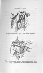 Fig. 3. Même technique. - Fin du 2e temps. Section des pectoraux / Fig. 4. La dissection au bistouri [...]