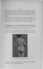 Fig. 7. Scoliose au cours de la maladie de Parkinson - Exposé des travaux scientifiques. Décembre 19 [...]