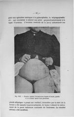 Fig. VIII. Femme opérée d'éventration depuis 18 mois, guérie et au dernier mois d'une grossesse - Ti [...]