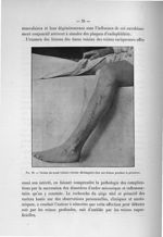 Fig. 10. Varices du canal veineux externe développées chez une femme pendant la grossesse - Notice s [...]