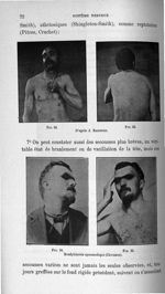 Fig. 32 / Fig. 33. D'après J. Babinski / Fig. 34 / Fig. 35. Bradykinésie spasmodique (Cruchet) - Tit [...]