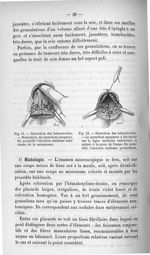 Fig. 11. Résection des hémorroïdes. - Dissection du manchon muqueux / Fig. 12. Résection des hémorro [...]