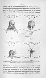 Fig. 4 / Fig. 5. Les temps principaux de l'opération de Delorme (fig. 2 et 3, dissection de la muque [...]