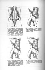 Fig. 45. A gauche, incision de Simon. A droite, incision de Guyon / Fig. 46. Incision de Küster / Fi [...]