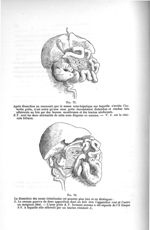 Fig. 75. Après dissection on reconnaît que la masse sous-hépatique sur laquelle s'arrête l'intestin  [...]