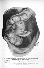 Fig. 98. Aspect après dissection d'une coudure colique (1re variété) avec mégacaecum provoquée par u [...]