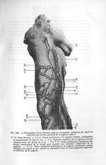 Fig. 142. Photographie d'une dissection faite sur un membre variqueux sur lequel on avait fait une r [...]