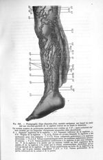 Fig. 143. Photographie d'une dissection d'un membre variqueux sur lequel on avait fait une résection [...]