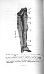 Fig. 144. Photographie d'une dissection faite sur un membre variqueux sur lequel on avait fait une r [...]