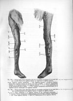 Fig. 145. Photographie d'une dissection faite sur un membre variqueux où on avait fait un an auparav [...]