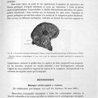 0147 - Page 137 - Anatomie pathologique générale. VI. Maladies infectieuses. Streptococcie, staphylococcie / Méningocoque