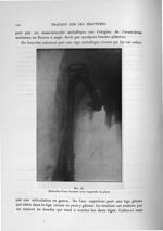 Fig. 28. Réduction d'une fracture avec l'appareil en place - Exposé des travaux scientifiques