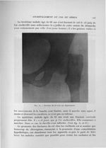 Fig. 30. Fracture du col avec son déplacement - Exposé des travaux scientifiques