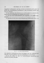 Fig. 31. La même fracture enchevillée - Exposé des travaux scientifiques