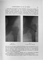 Fig. 32. Fracture du col / Fig. 33. La même fracture enchevillée - Exposé des travaux scientifiques