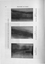 Fig. 36. Déplacement primitif / Fig. 37. Vue de profil après un mois de marche / Fig. 38. Vue de fac [...]