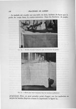 Fig. 39. Manière de faire l'extension pour les fractures de jambes / Fig. 40. Étrier pour faire l'ex [...]