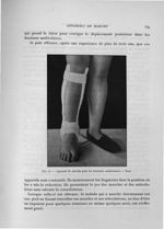 Fig. 43. Appareil de marche pour les fractures malléolaires. - Face - Exposé des travaux scientifiqu [...]