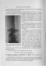 Fig. 44. Enchevillement péronéo-tibial pour fractures de Dupuytren vicieusement consolidée - Exposé  [...]