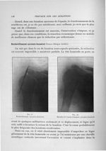 Fig. 45. Enchevillement acromio-huméral / Fig. 46. Résultat de l'enchevillement acromio-huméral - Ex [...]