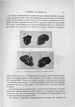 Fig. 48. Semi-lunaire avec fragment du scaphoïde fracturé - Exposé des travaux scientifiques